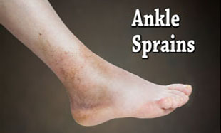ankle-sprain2