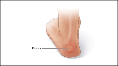 blisters4