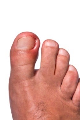 ingrown-toenail3