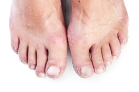 Ways Psoriasis Affects the Feet