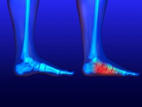 What is the Difference Between Flexible Flatfoot and Rigid Flatfoot?