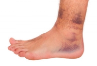 Ankle Sprains May Cause Ankle Pain