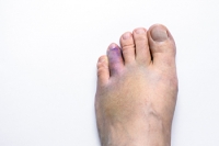 Facts About and Symptoms of a Broken Toe