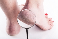 Remedies for Cracked Heels