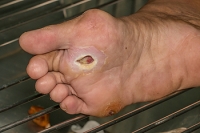 The Importance of Caring for Foot Wounds