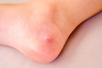 The Origins of Foot Blisters